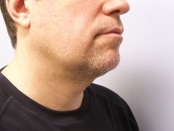 Chin/Neck Liposuction 593084