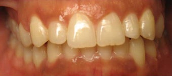 Invisalign 436971