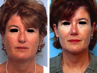 Rhinoplasty revision before 139113