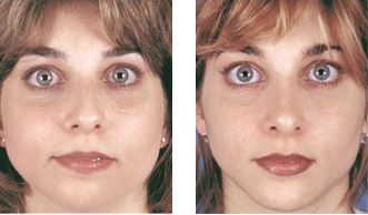 Rhinoplasty with chin implant front view before 6770