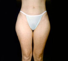 Smartlipo before 401656