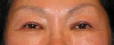 Asian Eyelid Surgery after 613751