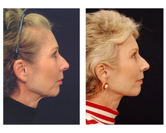Lower Face and Neck Lift after 355123