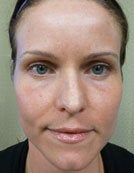 Fraxel Re:pair for Skin Rejuvenation after 196051