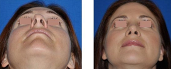 Revision Rhinoplasty before 293545