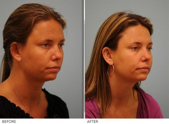 Otoplasty after 306851