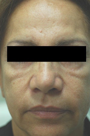 Cheek Shaping with Juvederm Los Angeles Before and After Photos before 204760