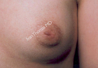 Nipple Surgery before 243260