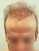 FUE – BHT by SFET Using Body and Head Hair to fix past Scalp Surgery before 195673