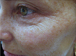 Fractional CO2 laser 459268