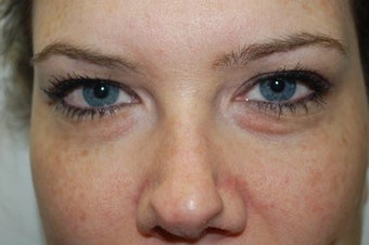 Restylane used in tear trough before 427909