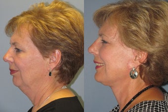 Lite Lift™, liposuction of the neck, lower eyelid lift before 523518