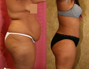 tummy tuck after 304683