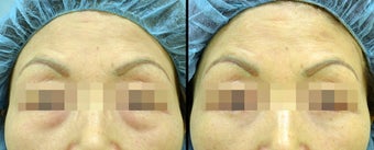 Lower Eyelid(Blepharoplasty) Surgery before 652278