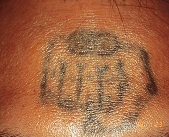 Laser tattoo removal before 374504