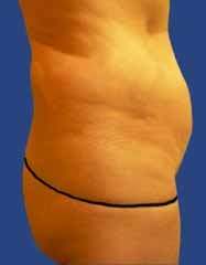 Abdomen Liposuction before 513402