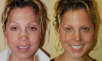 Revision Rhinoplasty Nose Surgery after 368726