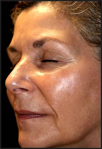Fraxel - Melasma before 652343
