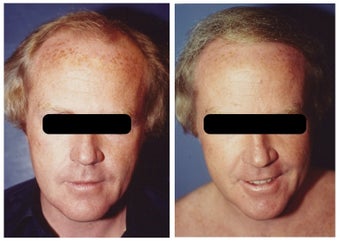 hair transplant before 369162