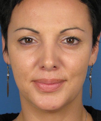 Revision Rhinoplasty after 410783