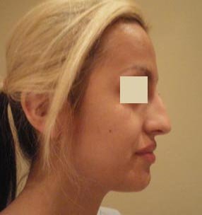 Rhinoplasty before 137956