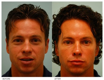 Botox, Fillers before 138520