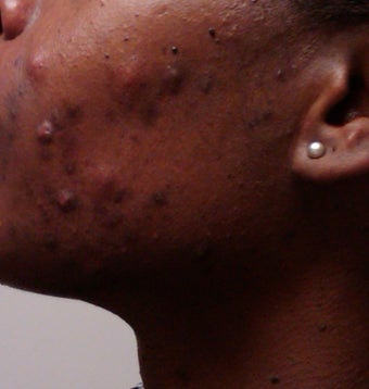 Accutane before 307754