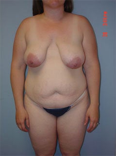 Mommy Makeover before 264612