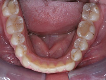 Invisalign after 372733