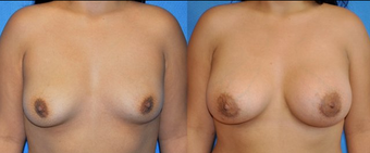 Flash Recovery Breast Augmentation (TM) before 256397