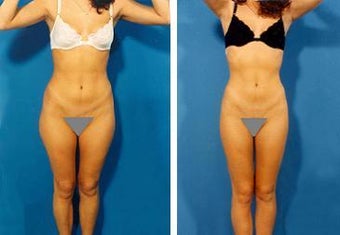 Liposuction before 636260