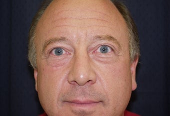 Blepharaoplasty before 343536