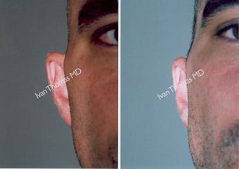 Ear Surgery - Otoplasty before 243393