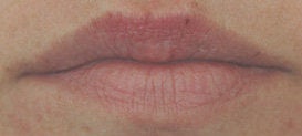Lip enhancement with Restylane after 93352