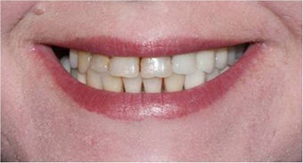 Smile Makeover with crowns and veneers before 367209