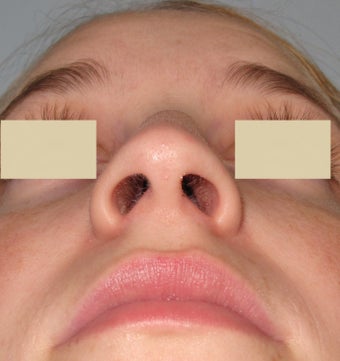 Rhinoplasty and Septoplasty after 127184