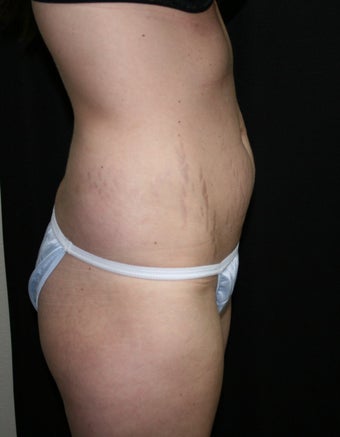 Abdominplasty (mini tummy tuck) before 263059