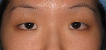 Double eyelid surgery by CO2 laser before 259535