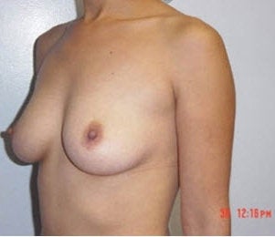 Breast implants before 171643