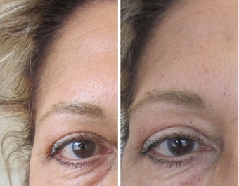 Tear Trough Injection before 387846
