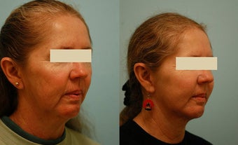 Otoplasty (Cosmetic Ear Pinning) before 136396