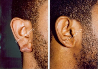 Earlobe Surgery before 243316
