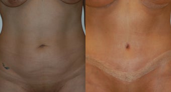 Tummy tuck before 143282