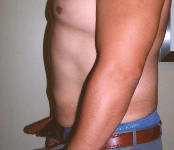 Abdominoplasty (Tummy Tuck) after 489726