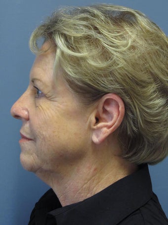 Neck Lift, Platysmaplasty 634752