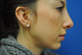 Chin Augmentation with Rhinoplasty after 582528