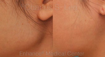 Jaw before 431365