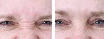 Botox for bunny lines before 6325