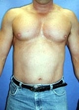 Pectoral Implants after 141617