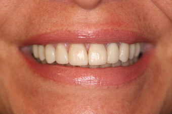 Porcelain Veneers Smile Makeover after 164361